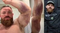 Sedminásobný vítěz Olympie Flex Lewis si při „neuvěřitelné“ nehodě utrhl tricepsovou šlachu od kosti, prý bude potřebovat operaci 