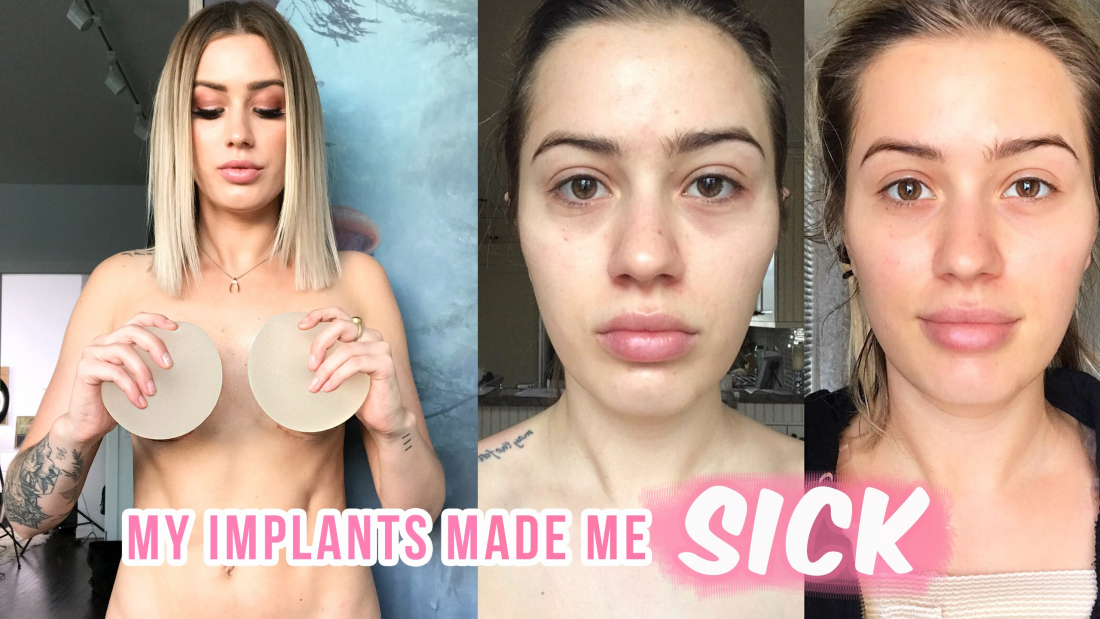 žena s prsními implantáty