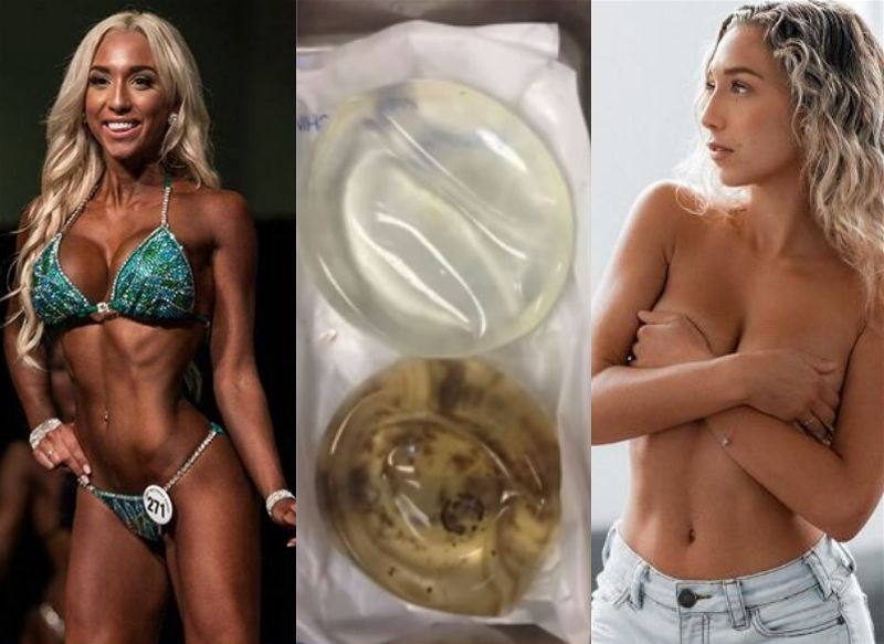 žena s prsními implantáty